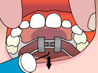 Why Won't My Palate Expander Key Turn? Troubleshooting Tips and Solutions