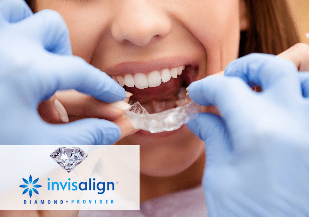 Invisalign Advantages vs Traditional Braces. What's the Better Option? -  Alicia Dental