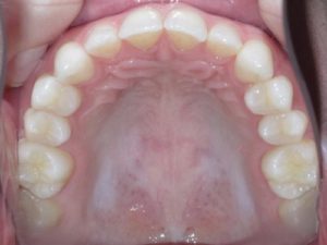 Step 2 - Occlusal Photo of Maxillary Dentition