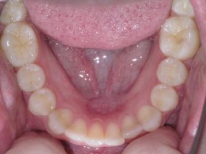 Step 3 - Occlusal Photo of Mandibular Dentition