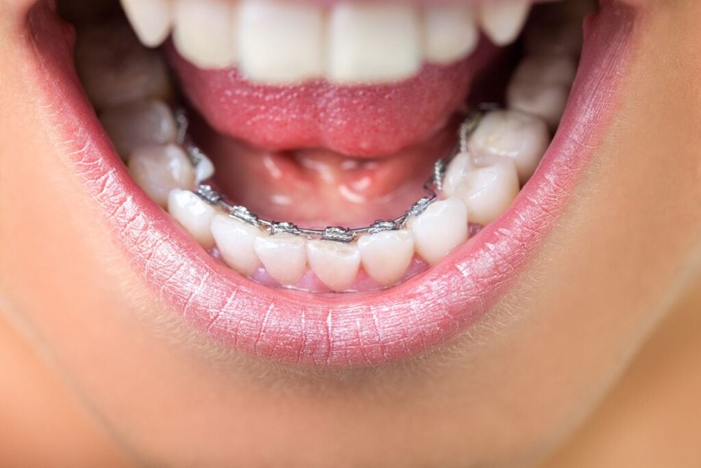 InBrace Lingual Braces Huntington NY