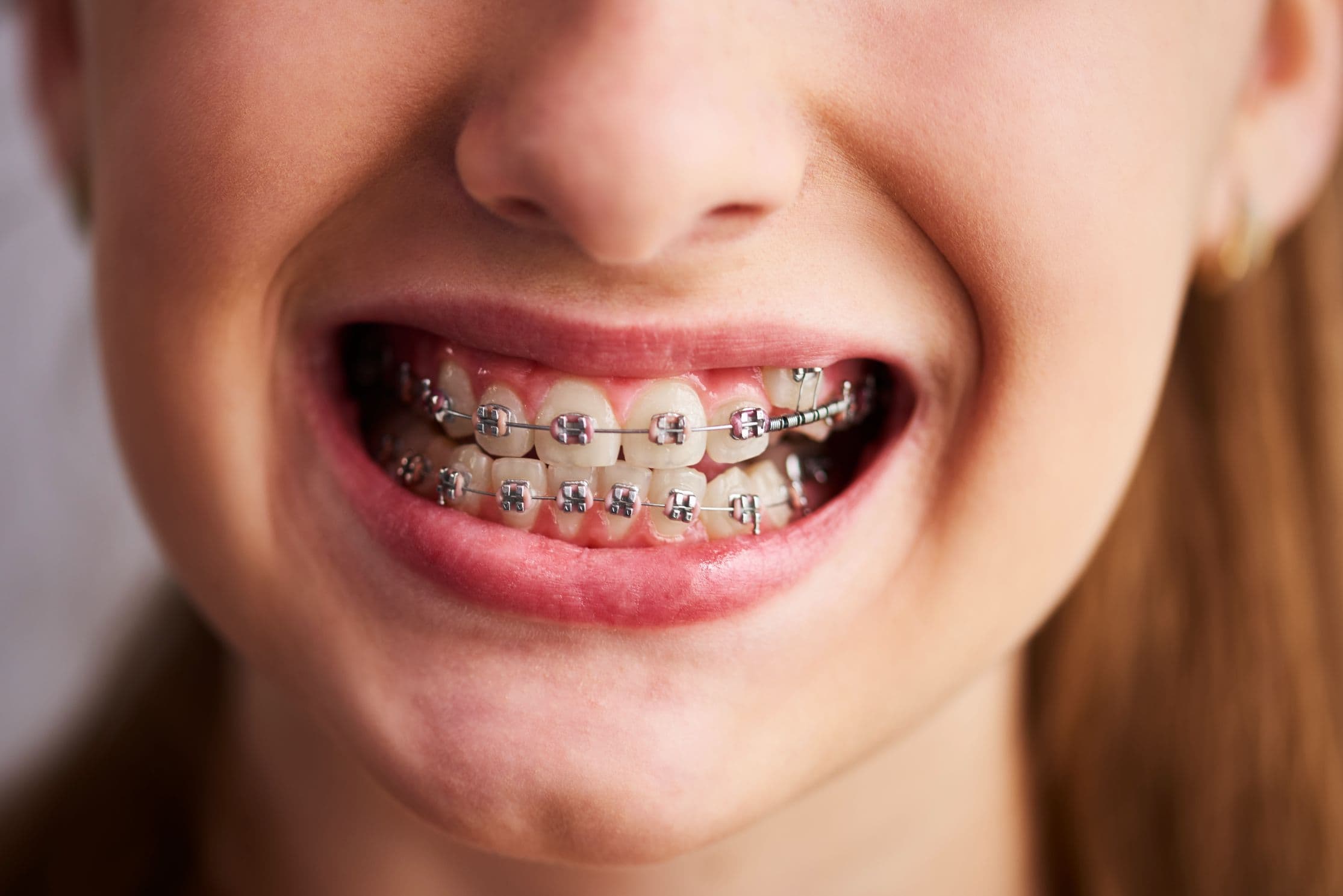 close-up shot of a smile with braces
