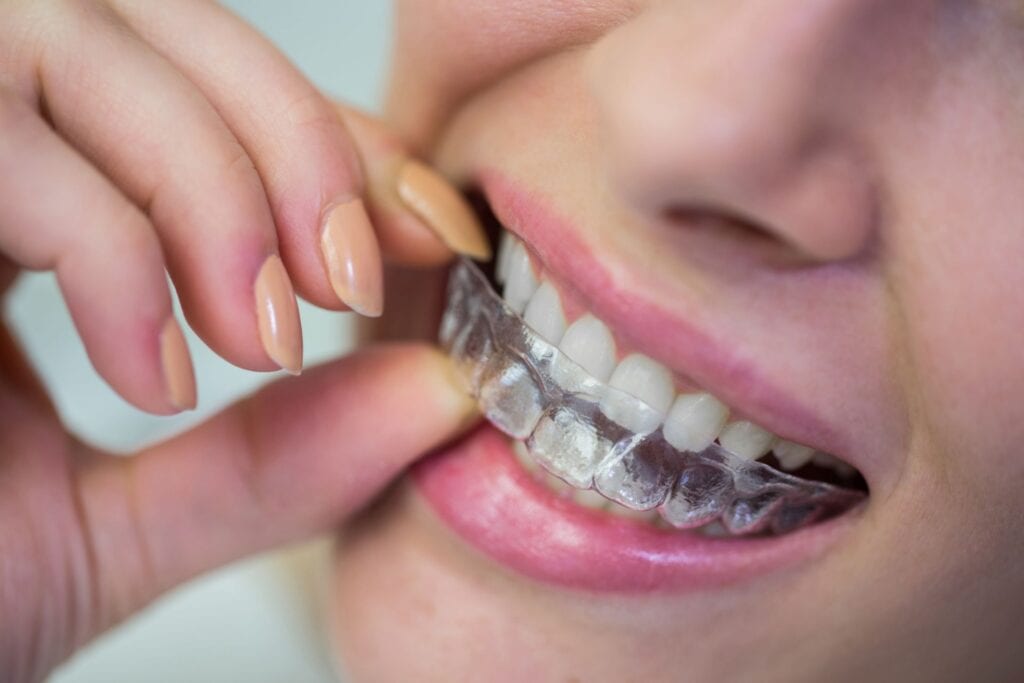 how-often-do-you-need-to-replace-your-dental-retainer